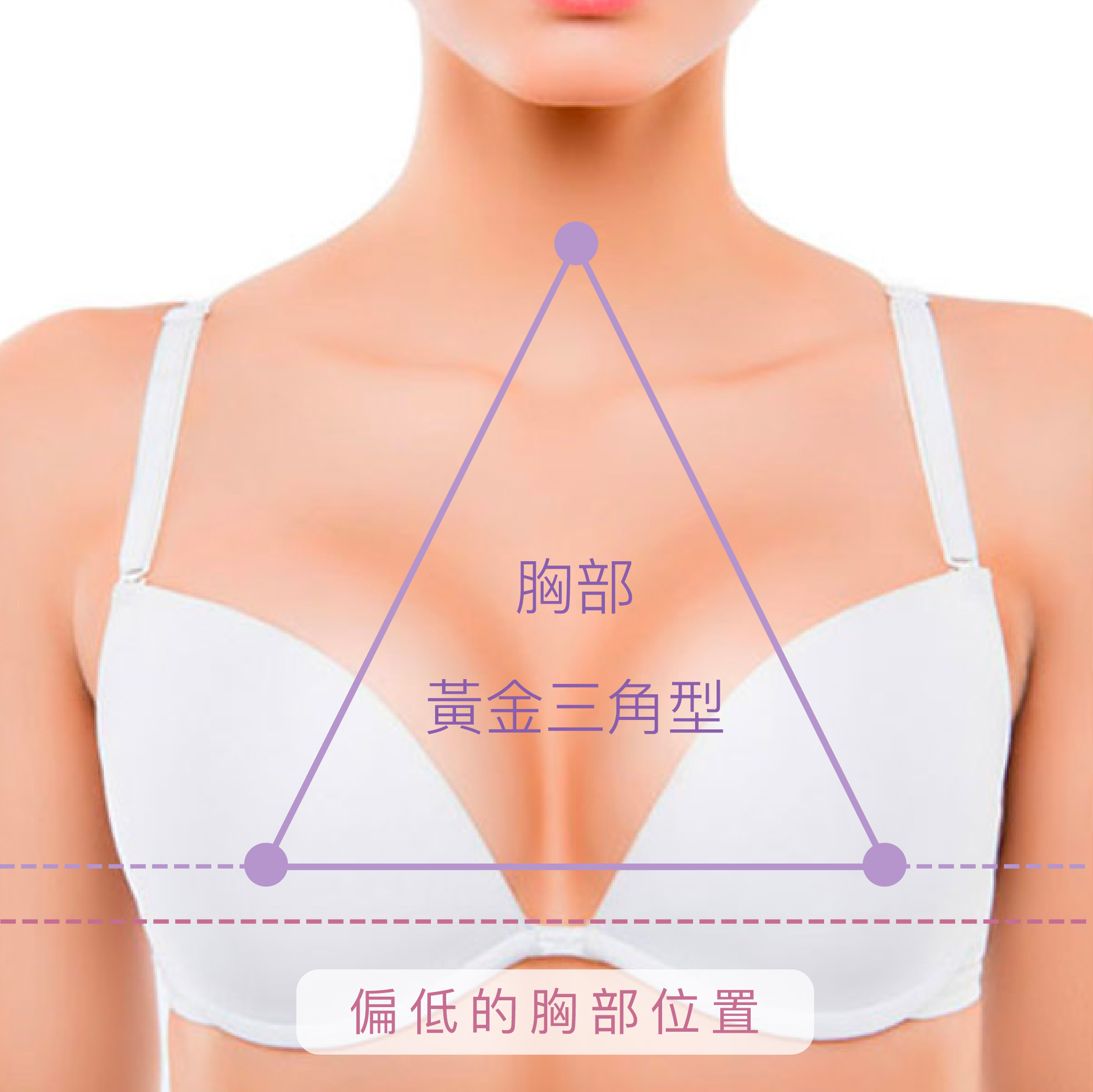 養護美胸療程｜活化乳狀腺組織｜提升胸部線條｜改善胸型｜女性保健｜疏通經絡改善淋巴瘀塞｜SKINMAX Medical 醫學美容